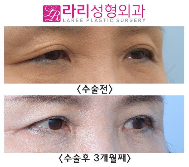 [Lari Plastic Surgery] The secret to looking 10 years younger in middle age is upper eyelid surgery! image 3