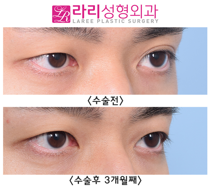 [Lari Plastic Surgery] Removing a Double Eyelid That Formed on Only One Side - Left? Right? Either Is Fine image 2