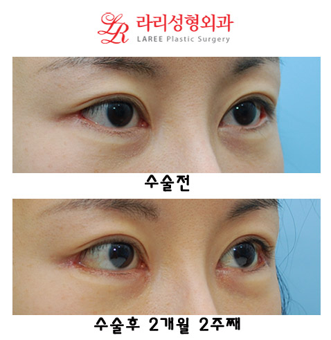 쌍꺼풀재수술(쌍꺼풀낮추는수술),뒤트임재수술,트임없는앞트임 관련 이미지 3