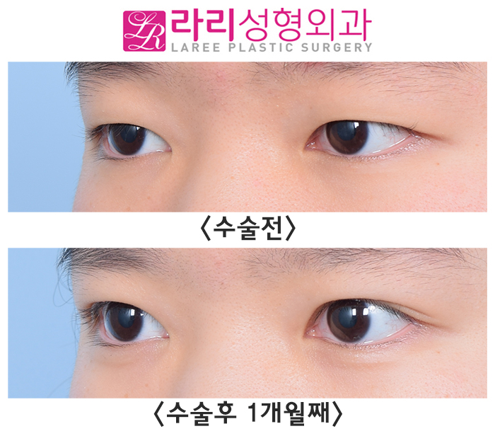 [라리성형외과] 비절개눈매교정 한 달 차 - 피부 절제 없이, 간단하고 또렷하게 관련 이미지 2