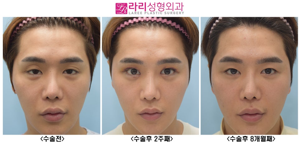 [라리성형외과] 여러겹 두꺼운 자연 쌍꺼풀 무쌍으로 풀기, 없애는 수술 관련 이미지 3