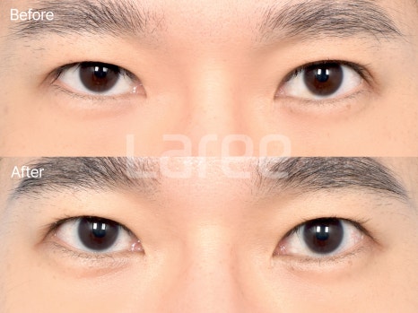 [Lari Plastic Surgery] Everything About Double Eyelid Removal Surgery image 8