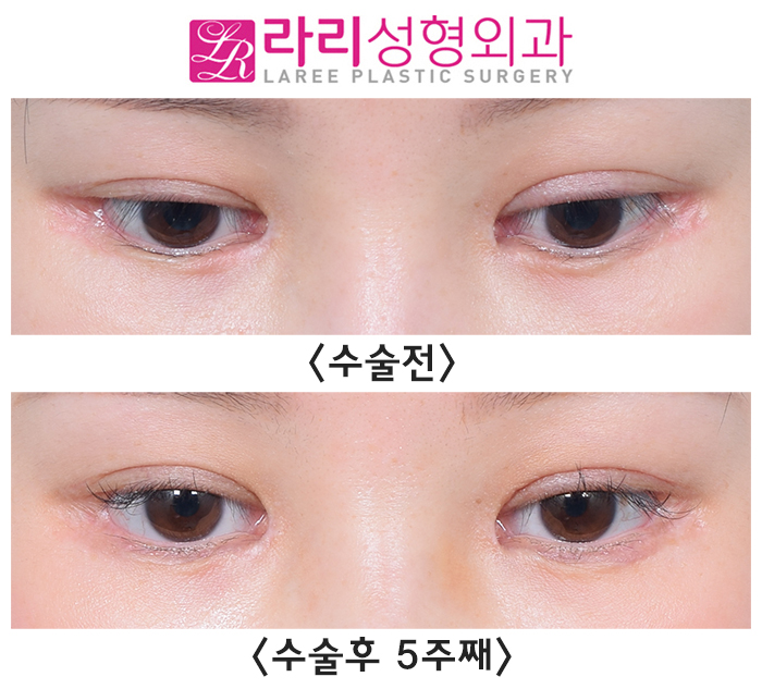 [라리성형외과] 한쪽 쌍수 재수술로 짝눈을 맞춰요. (절개쌍수라인낮추기) 관련 이미지 4