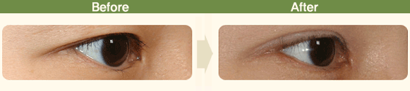 ☆Wangnuni Plastic Surgery☆ Before-and-after photos of epicanthoplasty and lateral canthoplasty with lowering of the outer eye corner: long-term follow-up of over 2 years! image 3