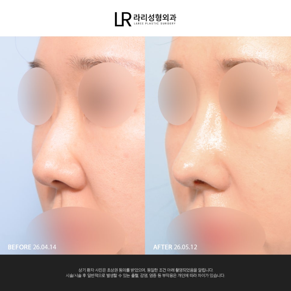 [Lari Plastic Surgery] If You Are Considering Nose Surgery, Do Not Get Nose Thread-Lifting Procedures Like Misko / Hiko!! image 6