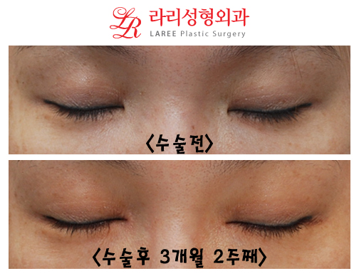 Before-and-After Photos of Epicanthoplasty / Canthoplasty image 2