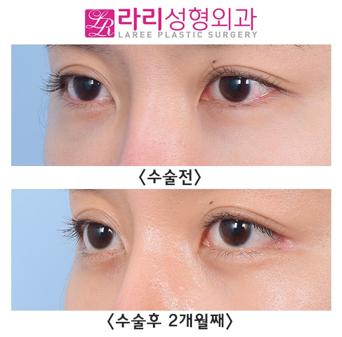 [라리성형외과] 다각도에서 바라보는 비대칭 뒤트임수술 관련 이미지 2