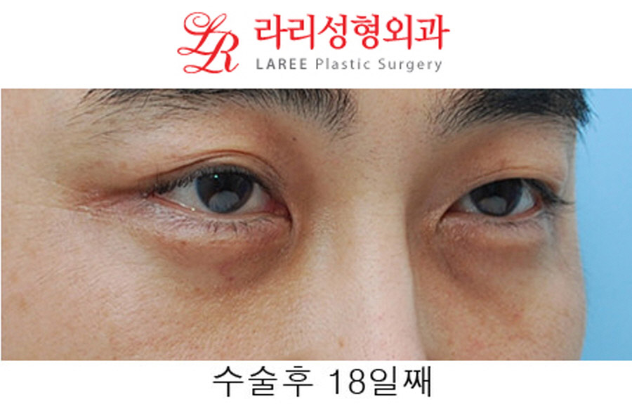 Under-Eye Fat Repositioning Before and After in Your 40s image 6