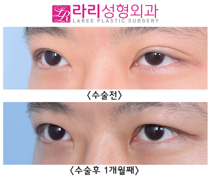 [라리성형외과] 쌍꺼풀없애는수술 한 달 차, 효과와 경과가 이 정도라고요?! 관련 이미지 3