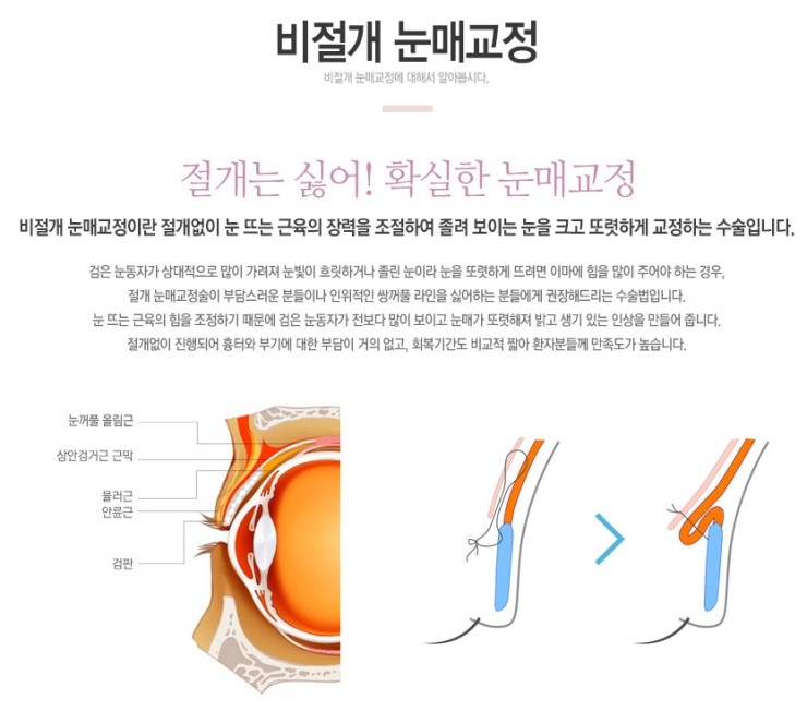 Non-Incisional Eye Correction Swelling, a Review Showing Its Effect image 1