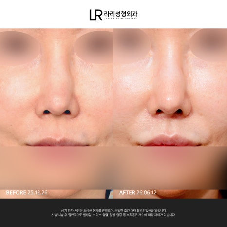 [라리성형외과] 사진 찍으면 유독 길어 보이는 인중, 인중축소로 달라질 수 있을까? 관련 이미지 4