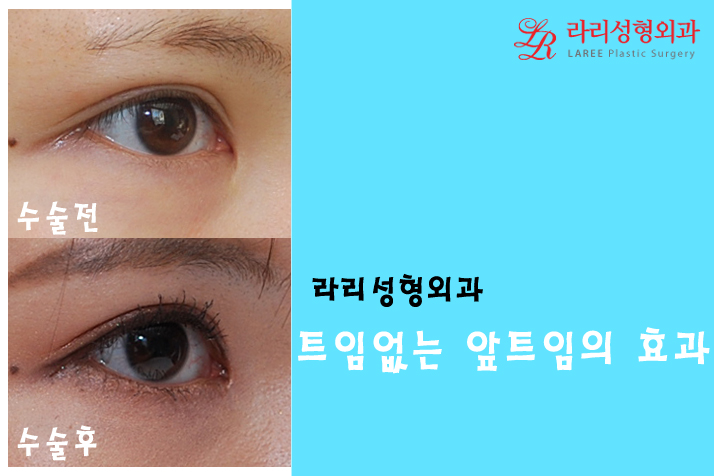 몽고주름, 더이상 헤매지말고 트임없는앞트임으로! 관련 이미지 6