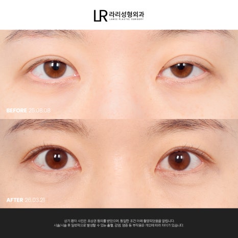 [라리성형외과] 눈 (재) 수술은 라리성형외과가 관련 이미지 9