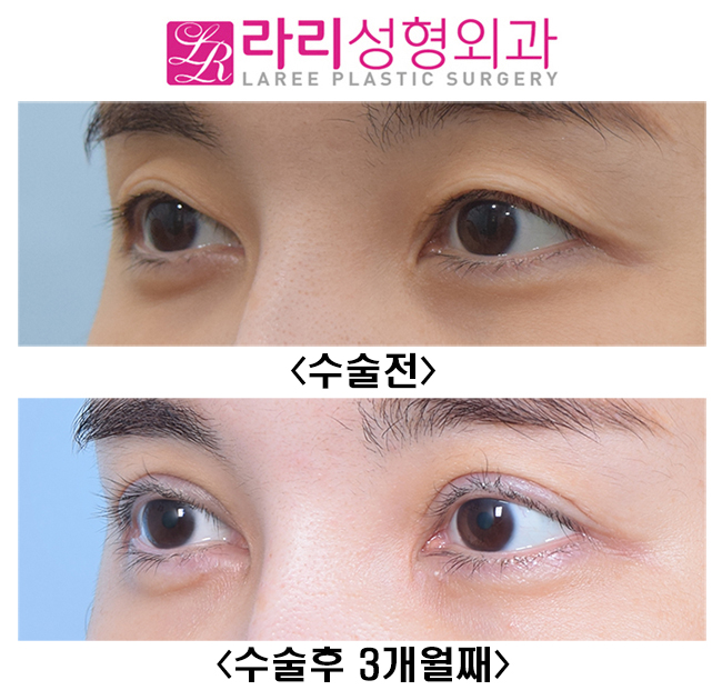 [라리성형외과] 풀린 쌍꺼풀재수술 아웃라인으로 크고 예쁘게 재탄생! 관련 이미지 3
