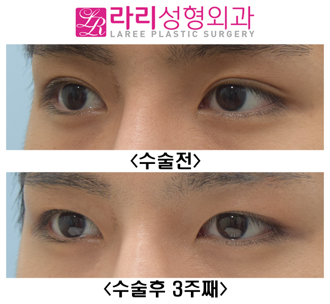 [라리성형외과] 인아웃라인 자연쌍꺼풀을 무쌍속쌍으로 만들기 관련 이미지 3