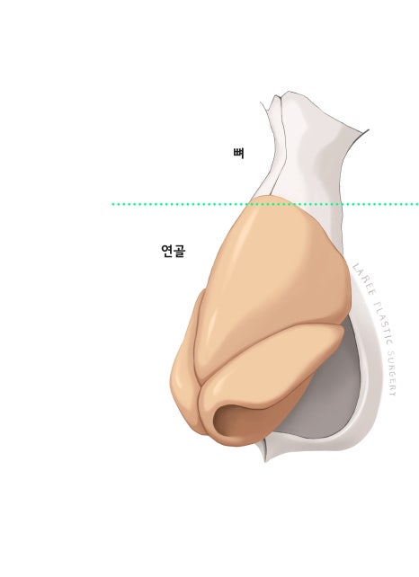 [라리성형외과] 절골을 포함한 매부리코 교정 수술(비순각 교정) 관련 이미지 2