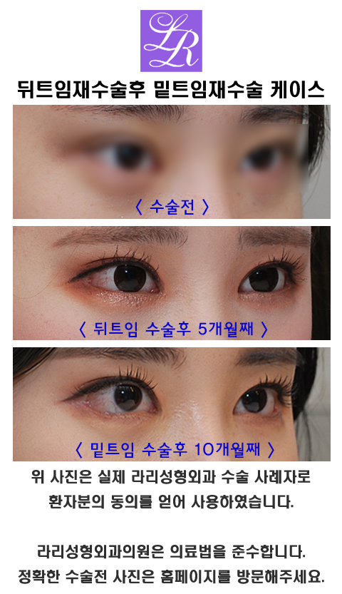 뒤트임재수술 하고나서 밑트임재수술 가능할까 관련 이미지 4