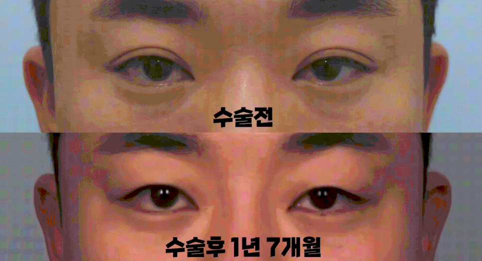 [라리성형외과] 쌍꺼풀없애기 무쌍수술, 자연스러운 변화와 눈 깜빡임을 확인하세요. 관련 이미지 3