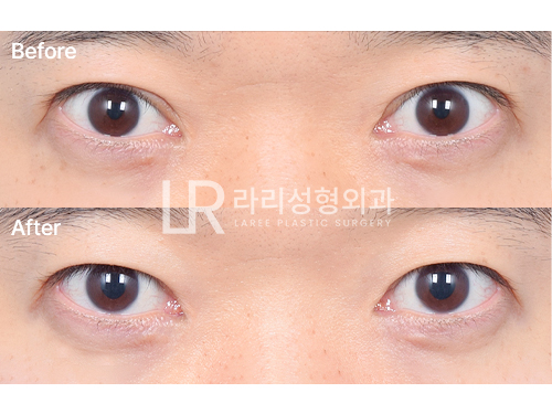 [LARI Plastic Surgery] The Best Time for Double-Eyelid Revision Surgery: Before and After Removing an Incisional Double-Eyelid Line One Year After Surgery image 4