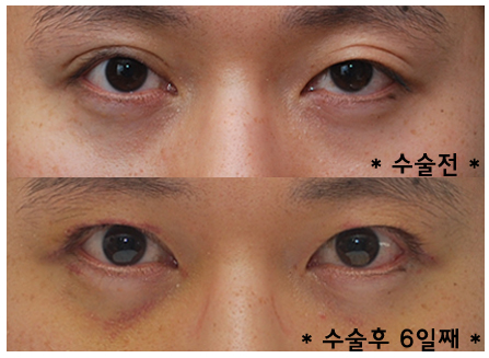 비절개눈매교정 - 미세 눈 비대칭 짝짝이 교정 관련 이미지 1