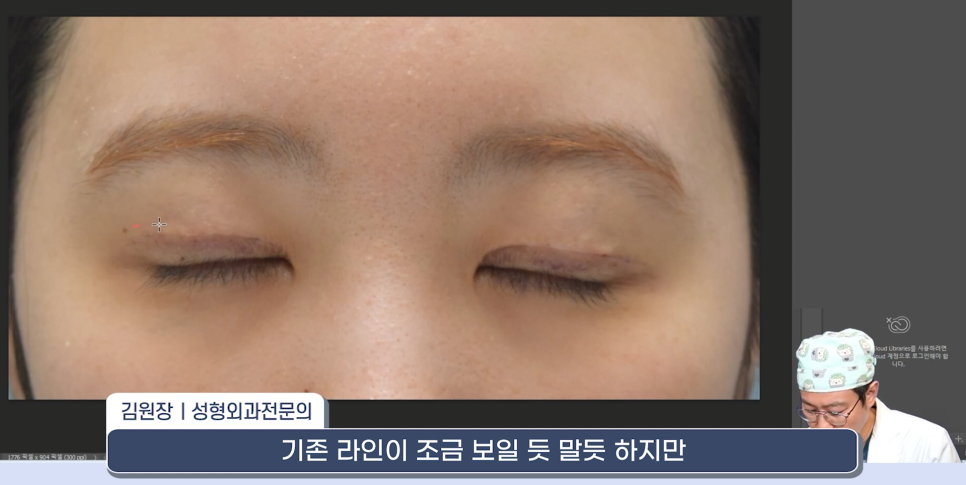 [라리성형외과] 쌍꺼풀재수술 라인 낮추는 두 가지 수술법 (절제방법 , 두줄따기방법) 관련 이미지 17