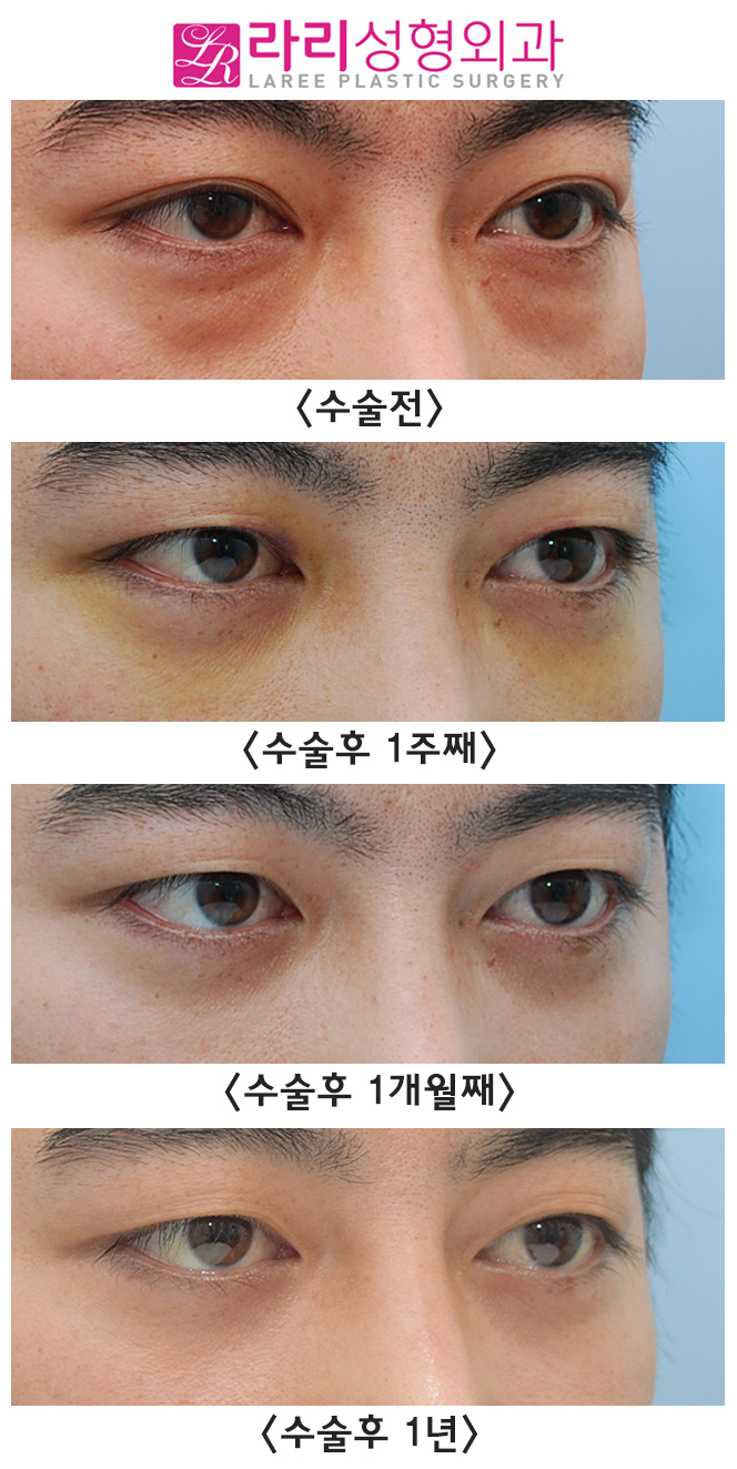 [Lari Plastic Surgery] Analysis of the Before-and-After Course of Non-Incisional Double Eyelid Removal Surgery, Which Is Effective but Has Weaknesses image 1
