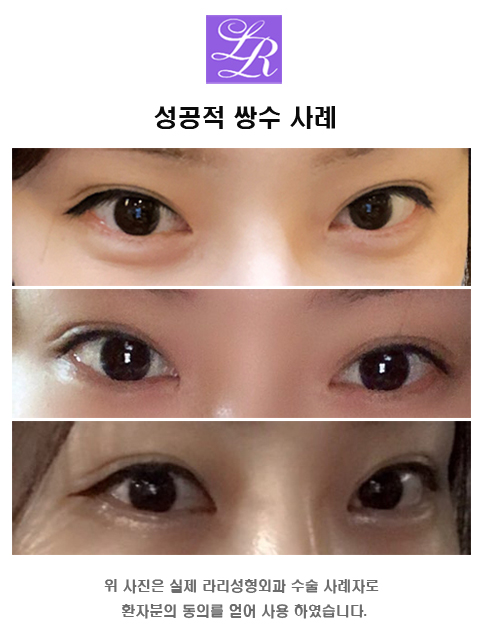 자연유착 쌍꺼풀잘하는곳, 다양한 케이스를 보여준다면 관련 이미지 3