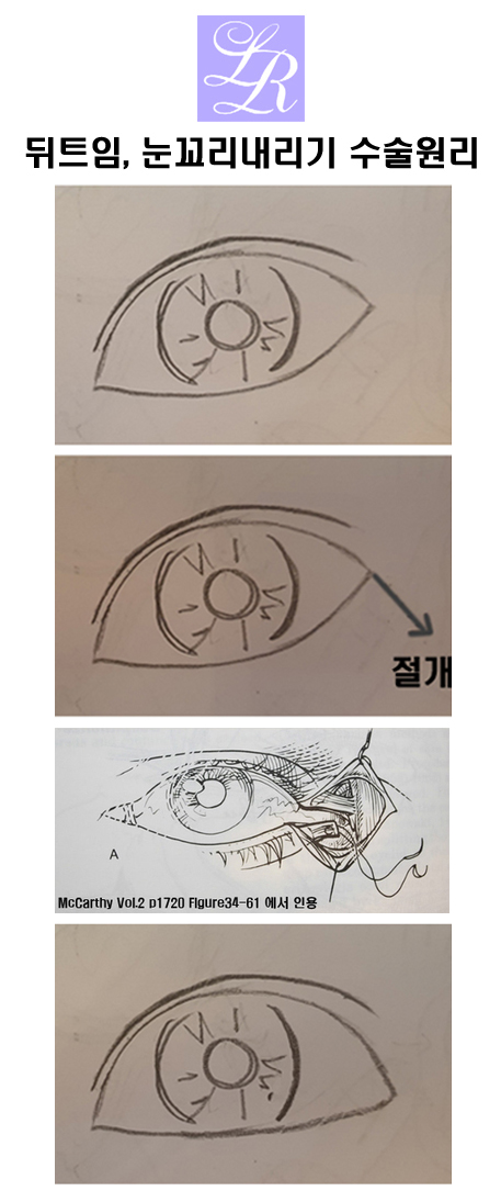 Detailed Explanation of the Principle of Lateral Canthoplasty and Eye Corner Lowering Surgery image 5