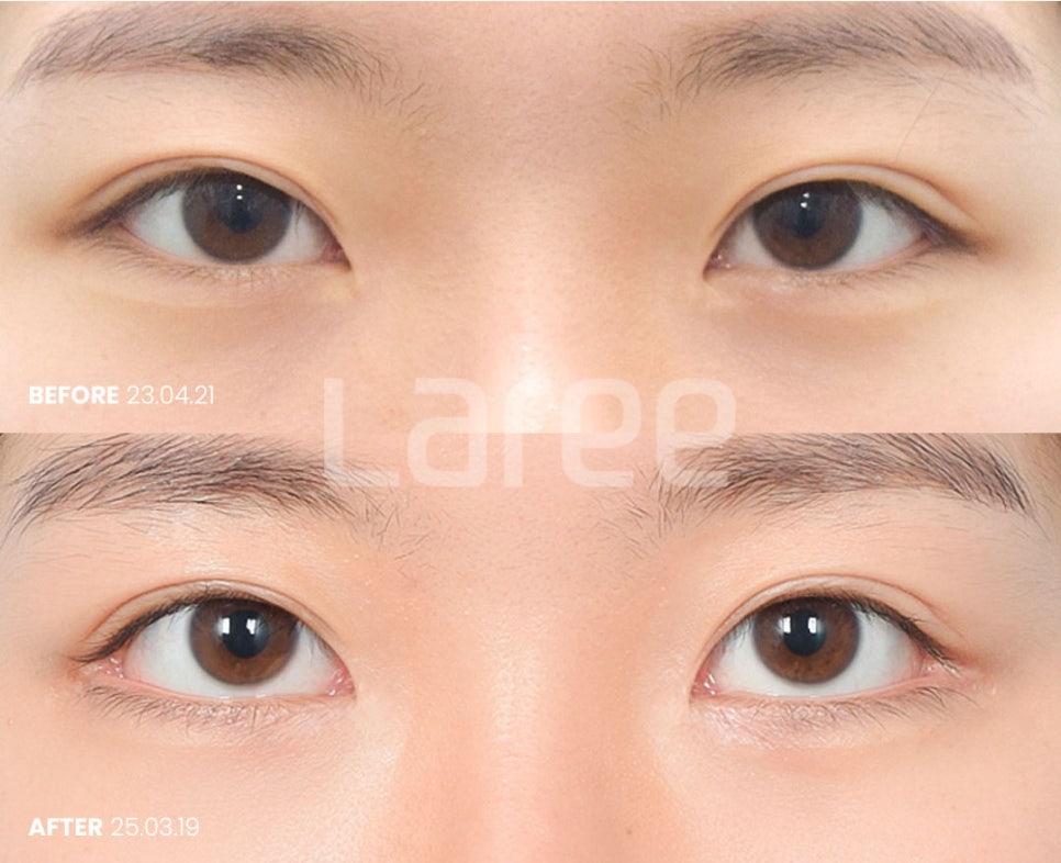 [LaLi Plastic Surgery] Outer Canthus Lowering Surgery, If It’s a Revision Surgery, It Must Be Done at a Place That Does It Well. image 1