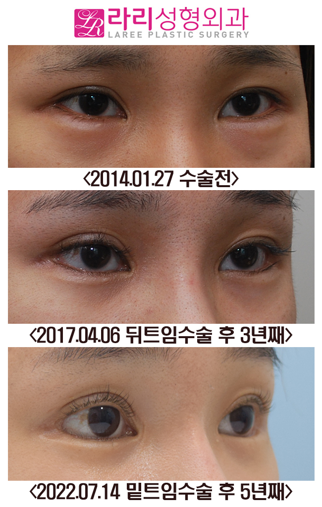 [라리성형외과] 뒤트임, 밑트임 수술 후 장기경과 전후사진 관련 이미지 2
