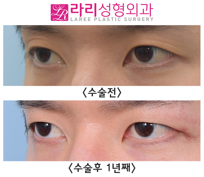 [라리성형외과] 여러 가지 쌍꺼풀 생기는 눈 무쌍으로 바꿔드립니다. 관련 이미지 8