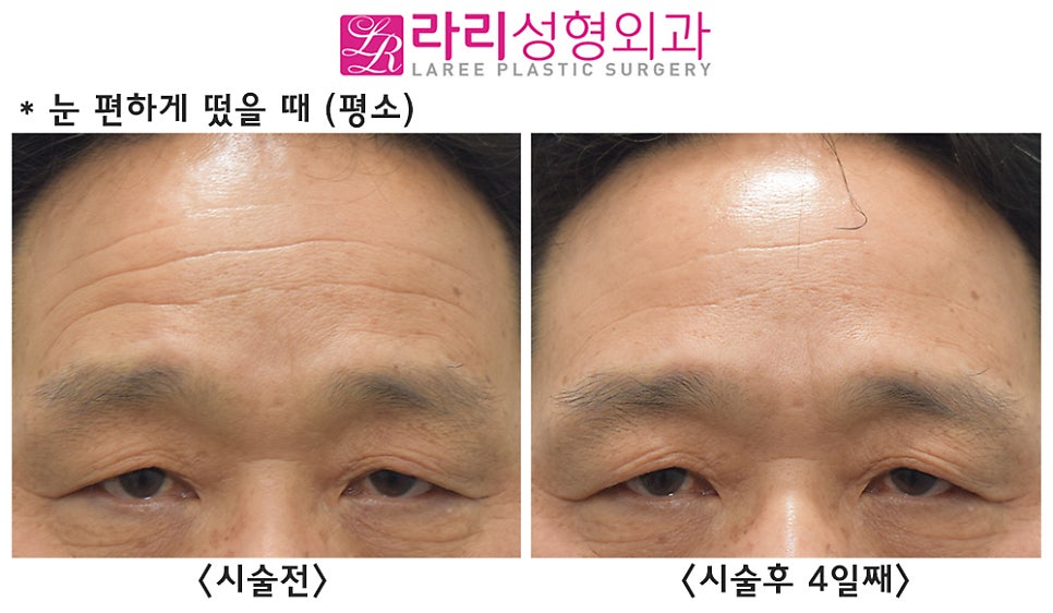 [라리성형외과] 이마 보톡스 효과 전후 사진 이마주름 얼마나 좋아지나 관련 이미지 5