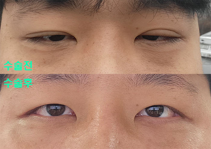 [라리성형외과] 쌍꺼풀없애기 무쌍눈매교정 수술 셀카 전후 비교 관련 이미지 2