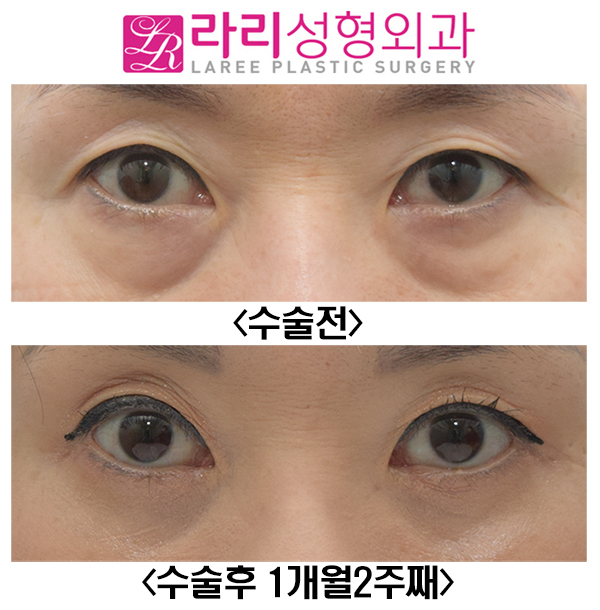 [Lari Plastic Surgery] Short-Term Before-and-After Photos of Lower Blepharoplasty: How to Avoid Ectropion image 1