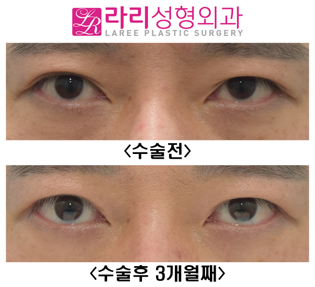 [Lari Plastic Surgery] Surgery to remove double eyelids only removes the double eyelids. image 1