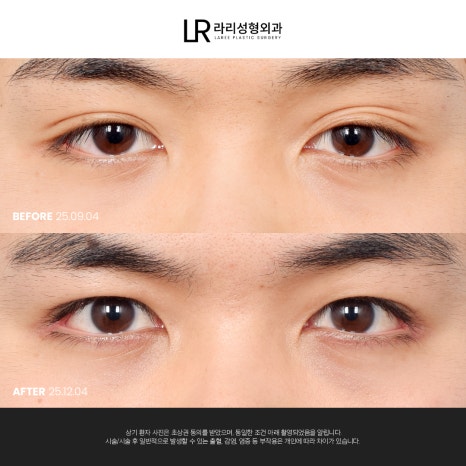 [라리성형외과] 눈 (재) 수술은 라리성형외과가 관련 이미지 13