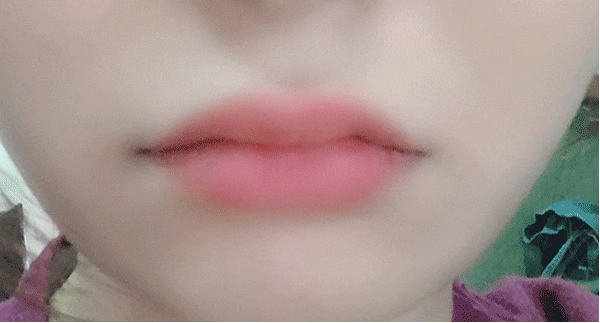 How to Make the Corners of the Mouth Lift Beautifully with Lip Corner Filler image 16