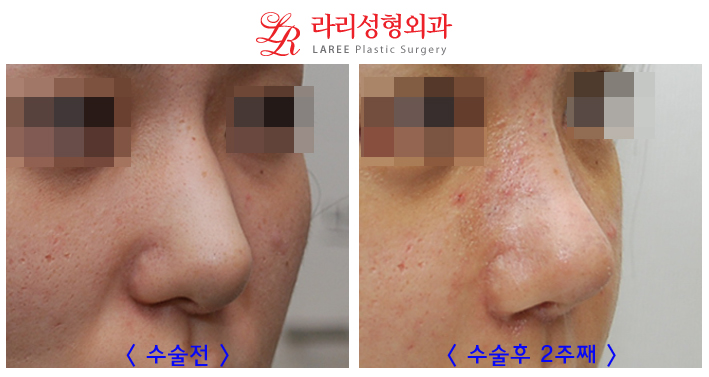 코재수술 잘하는곳 변화가 확실한 라리성형외과! 관련 이미지 5