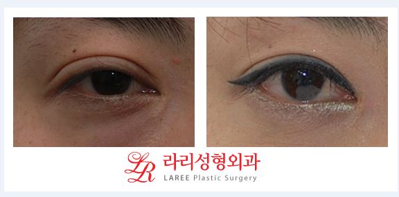 ※What Is the Wise Choice for Double Eyelid Revision Surgery?※ image 2