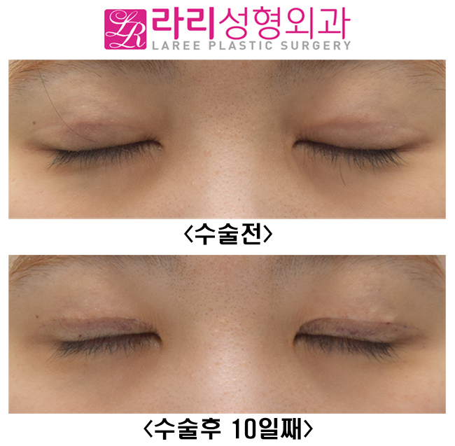 [Lari Plastic Surgery] Double Eyelid Revision Surgery with Line Lowering Combined with Ptosis Correction Surgery image 4