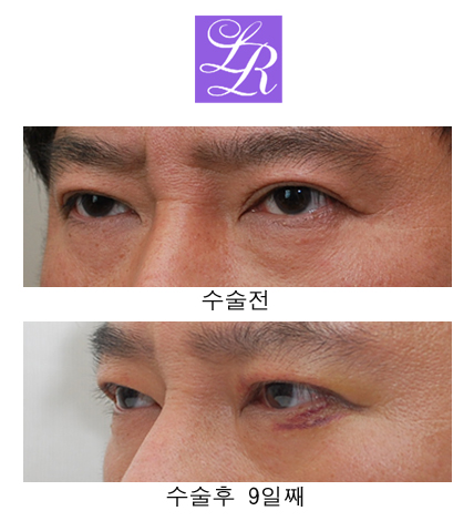 쌍꺼풀 푸는 수술/ 없애기 차이점은? 관련 이미지 7