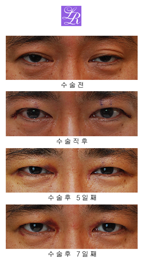 Are you curious about the recovery after double eyelid correction surgery for double eyelid side effects ...? image 3