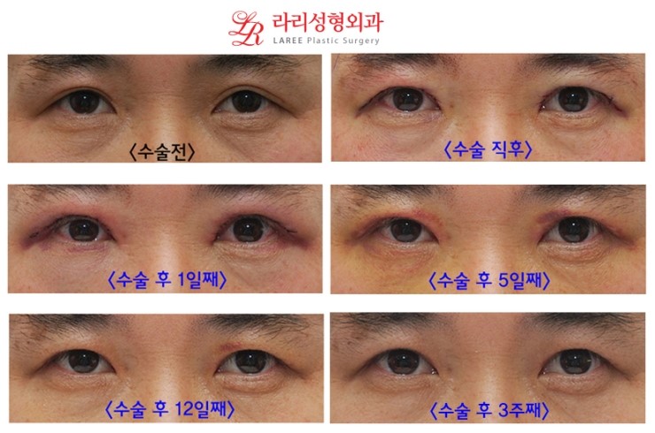 ☆남자는 홑꺼풀이 대세다!!! XTM 남자 쌍꺼풀 없애는 수술/쌍꺼풀 푸는 수술 전후사진 ☆ 관련 이미지 2