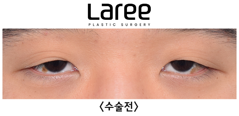 [Lari Plastic Surgery] Eyelid Correction Surgery and Upper Canthoplasty: Experiencing the Maximum Effect of Non-Double-Eyelid Eyelid Correction Without Medial Drooping image 1