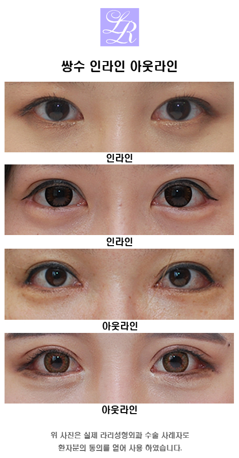 눈수술종류 뭐가 있나요? 관련 이미지 2