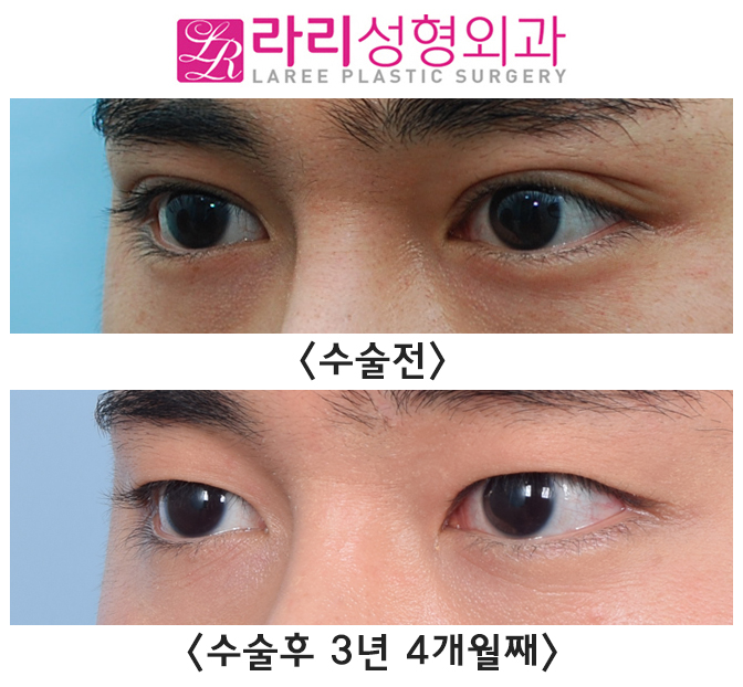[라리성형외과] 매몰 쌍수, 쌍꺼풀 없애는 수술 장기 경과 전후 사진 그리고 실제  동영상 관련 이미지 4
