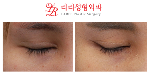 Restoration of Epicanthoplasty and Removal of Sunken Double Eyelid Scars image 5