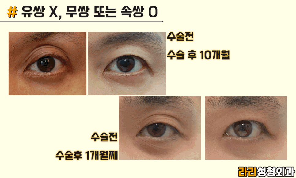 [Lari Plastic Surgery] Men’s Eye Surgery, Trends and Desired Look - Monolid & Hidden Double Eyelid image 5