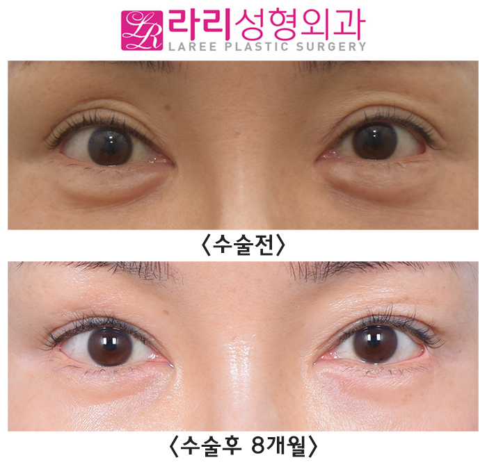 [Laree Plastic Surgery] Aegyo Filler? Permanent Filler? No More Foreign Materials image 1