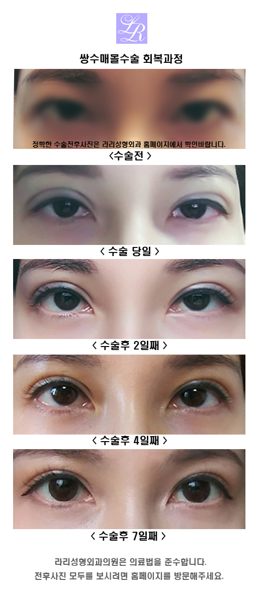 자연유착 쌍꺼풀잘하는곳, 다양한 케이스를 보여준다면 관련 이미지 4